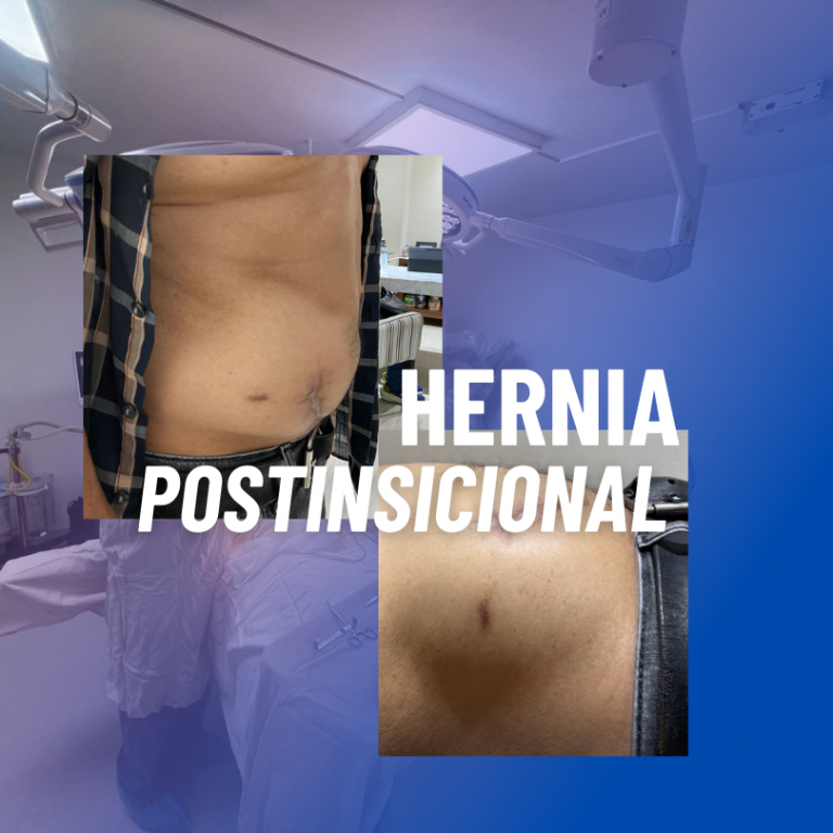 ¿Qué es una hernia postinsicional? - herniascuernavaca.com