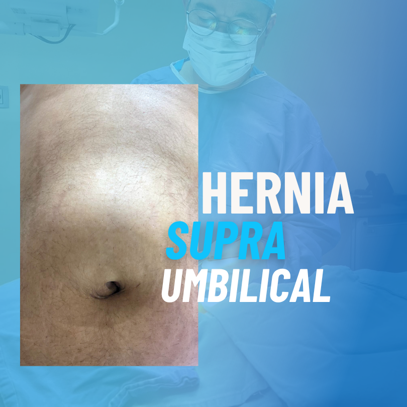 supra umbilical hernia doctor oscar alejandro lópez caro