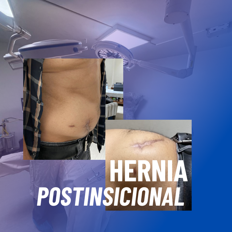 Hernia Postinsicional doctor hernias cuernavaca