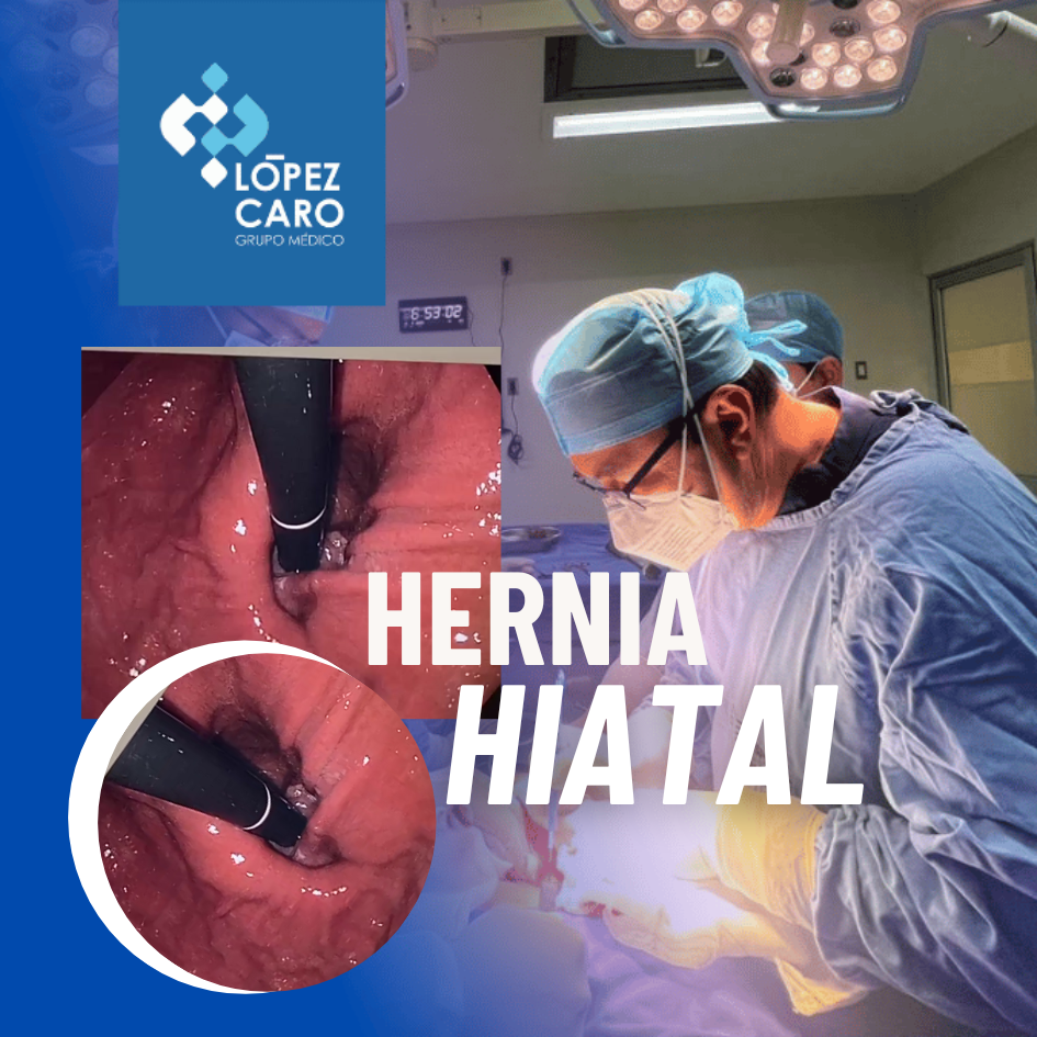 hernia postinsicional DOCTOR OSCAR (3)