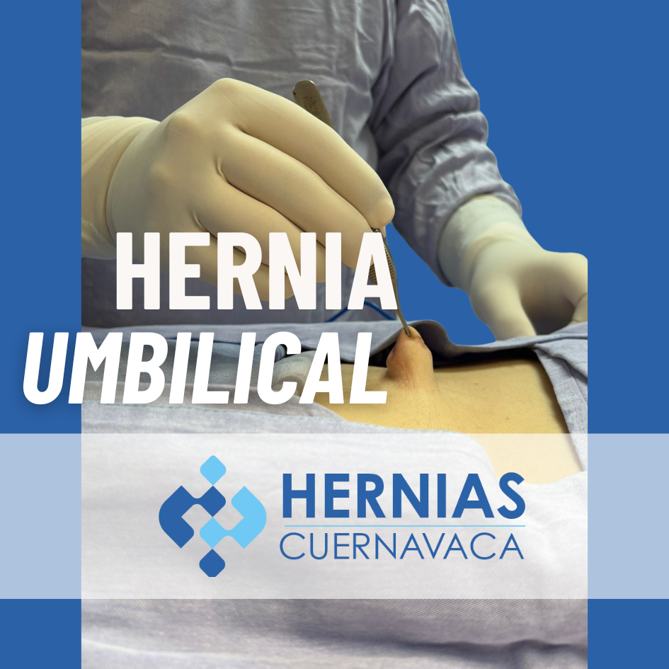 hernia umbilical