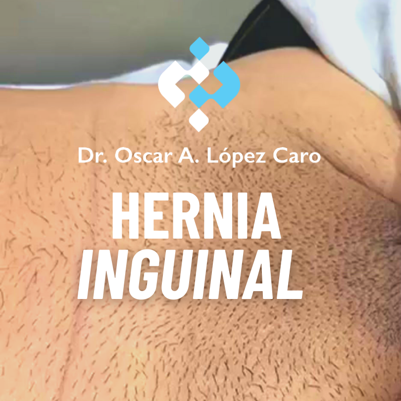 supra umbilical hernia doctor oscar alejandro lópez caro (3)