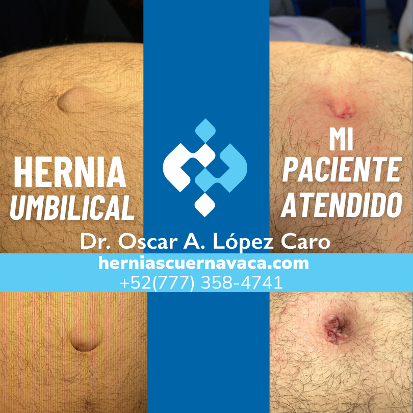 supra umbilical hernia doctor oscar alejandro lópez caro (4)